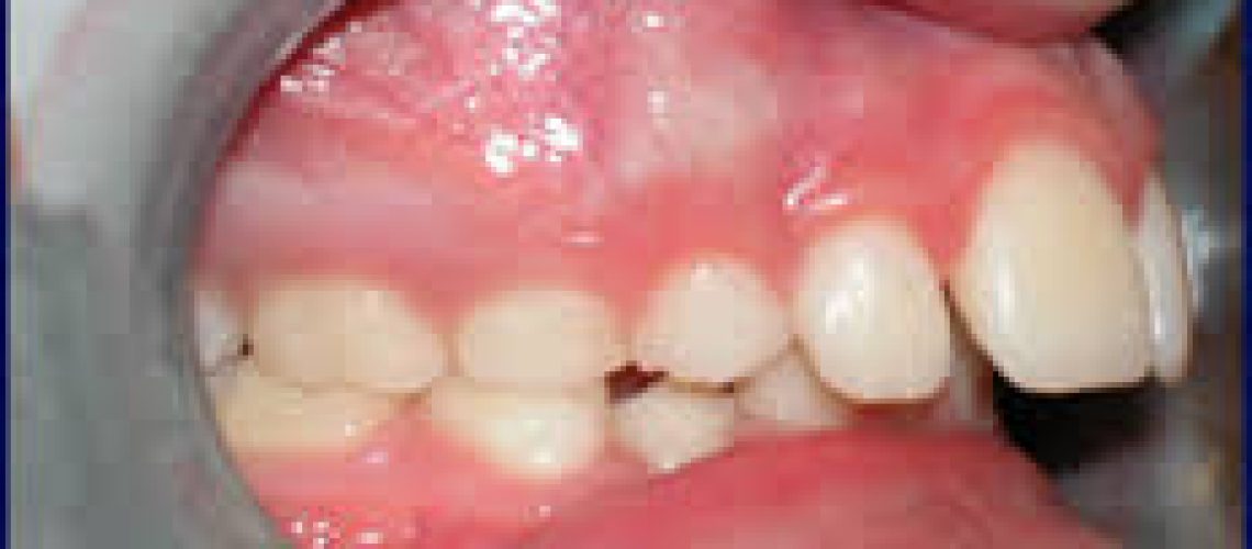 Overbite2